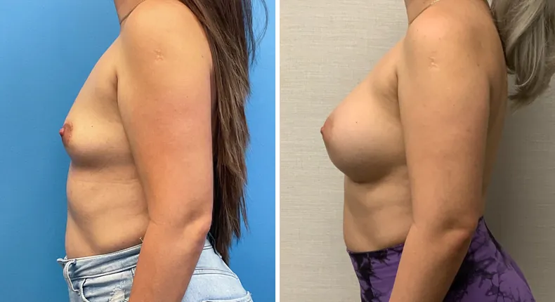 Before and after breast augmentation: woman's breasts from the left side