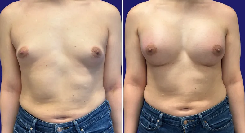 Before and after breast augmentation: woman's breasts