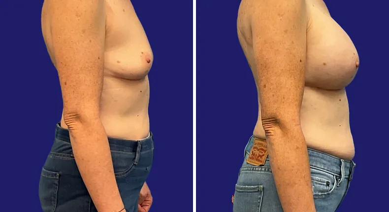 Before and after breast augmentation: woman's breasts