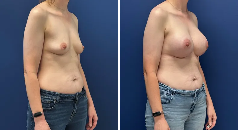 Before and after breast augmentation: patient's breasts at a right angle