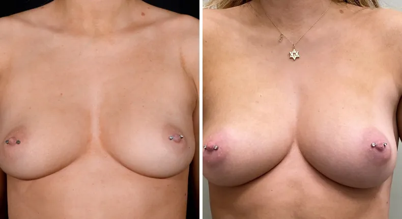 Before and after breast augmentation: patient's breasts from the front