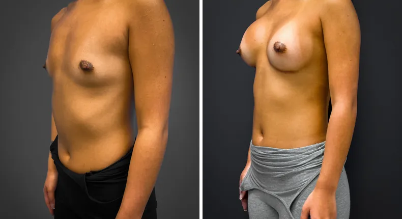 Before and after breast augmentation: patient's breasts from the left side