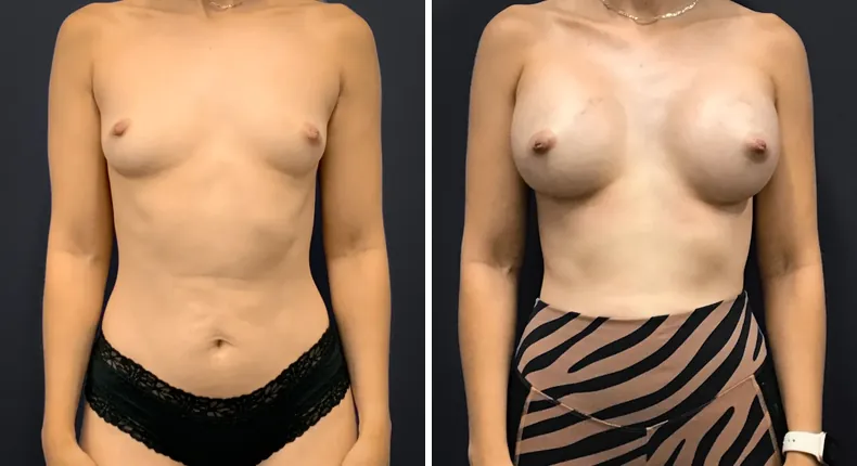 Before and after breast augmentation: patient's breasts from the front