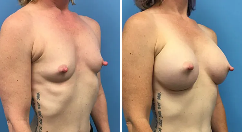 Before and after breast augmentation: woman's breasts at a right angle
