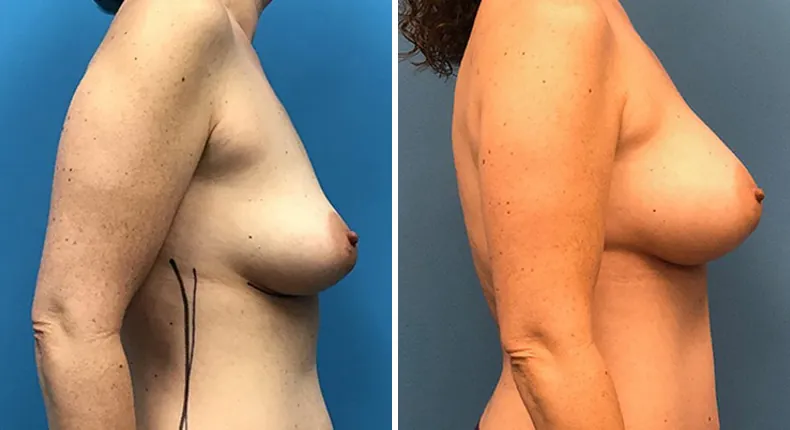 Before and after breast augmentation: woman's breasts from the right side