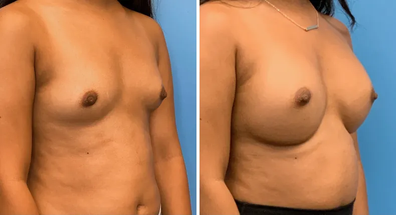 Before and after breast augmentation: patient's breasts at a right angle