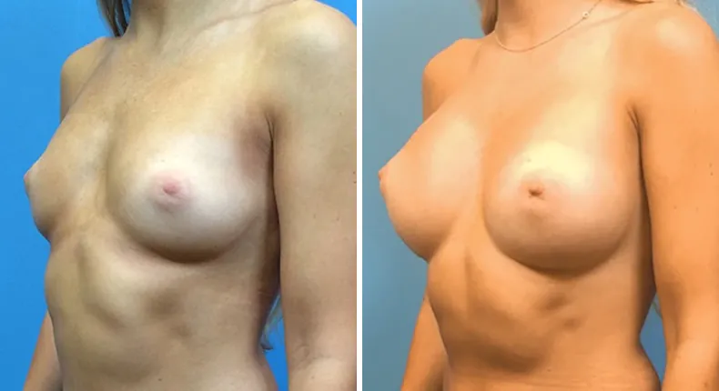 Before and after breast augmentation: woman's breasts at a left angle
