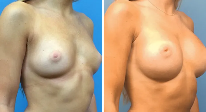 Before and after breast augmentation: woman's breasts at a right angle