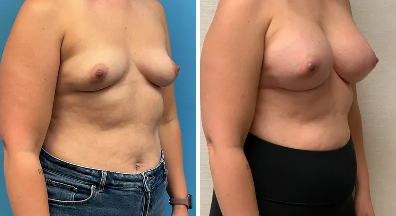 Before and after breast augmentation: woman's breasts at a right angle
