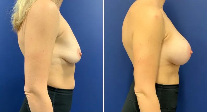 Before and after breast augmentation: woman's breasts from the right side