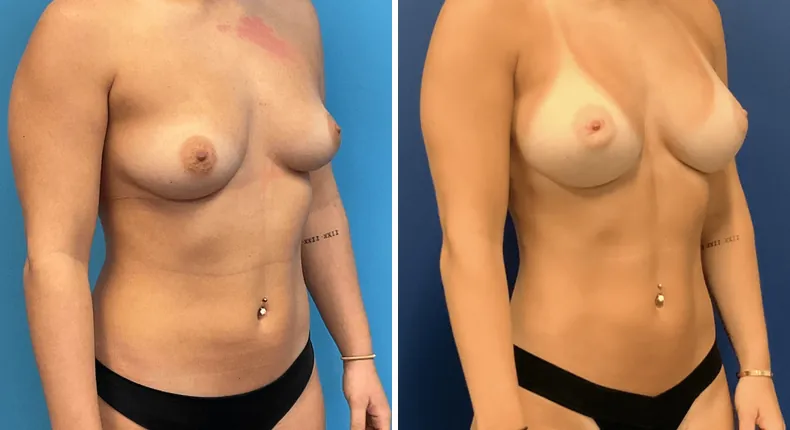 Before and after breast augmentation: patient's breasts at a right angle
