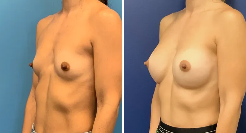Before and after breast augmentation: woman's breasts at a left angle