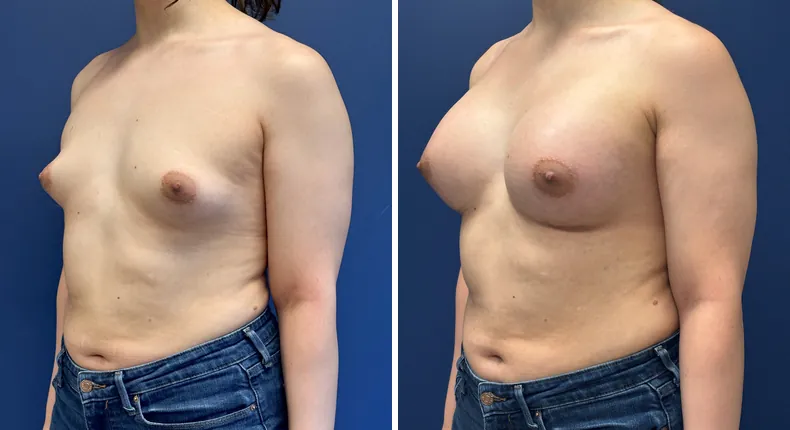 Before and after breast augmentation: woman's breasts at a left angle