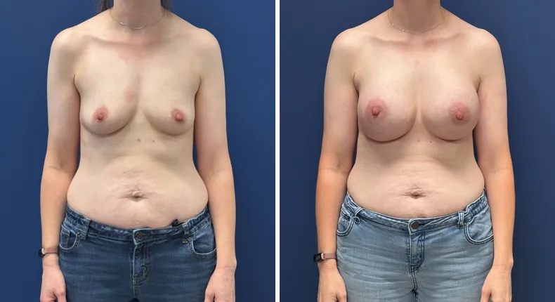Before and after breast augmentation: patient's breasts from the front