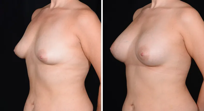 Before and after breast augmentation: patient's breasts at a left angle