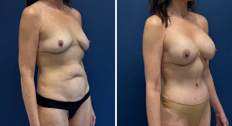 Before and after breast augmentation: patient's breasts at a right angle, with tummy tuck