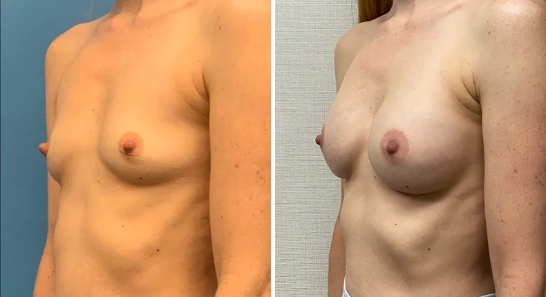 Before and after breast augmentation: woman's breasts at a left angle