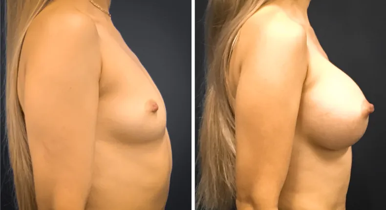 Before and after breast augmentation: woman's breasts in right profile