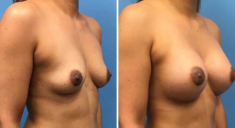 Before and after breast augmentation: woman's breasts at a right angle