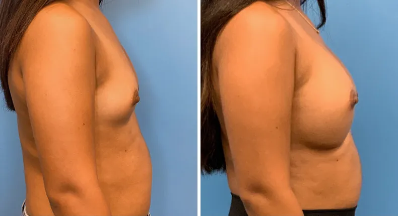 Before and after breast augmentation: patient's breasts from the right side