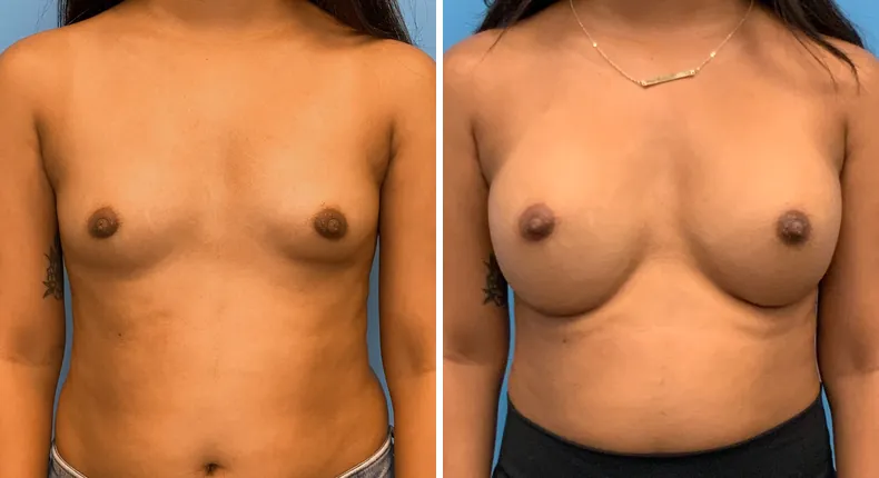 Before and after breast augmentation: patient's breasts from the front