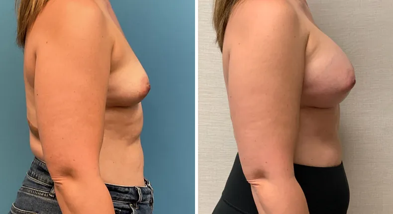 Before and after breast augmentation: woman's breasts from the right side