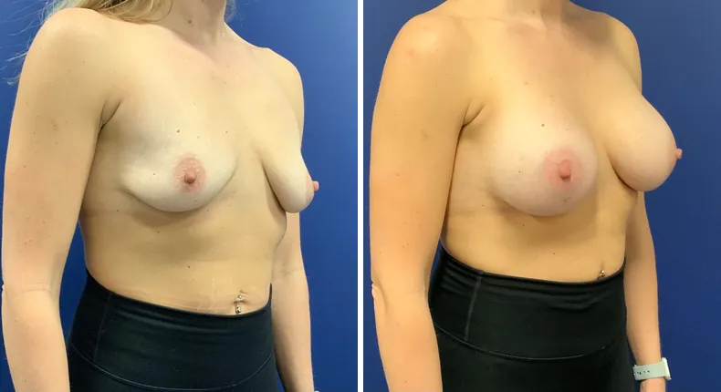 Before and after breast augmentation: woman's breasts at a right angle