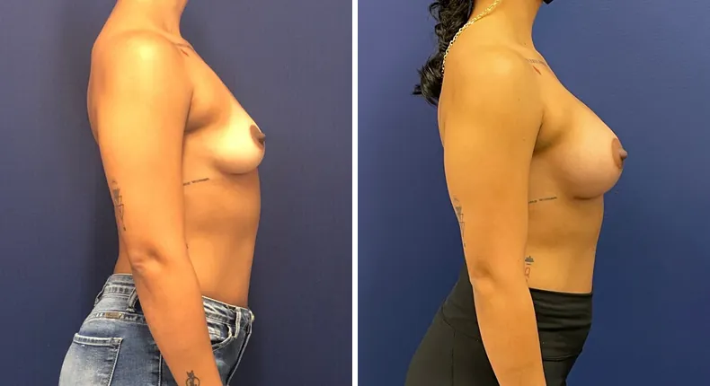 Before and after breast augmentation: patient's breasts from the right side