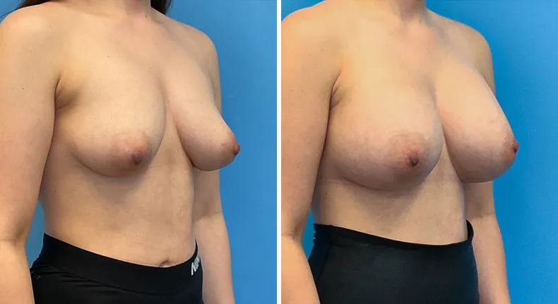 Before and after breast augmentation: patient's breasts at a right angle