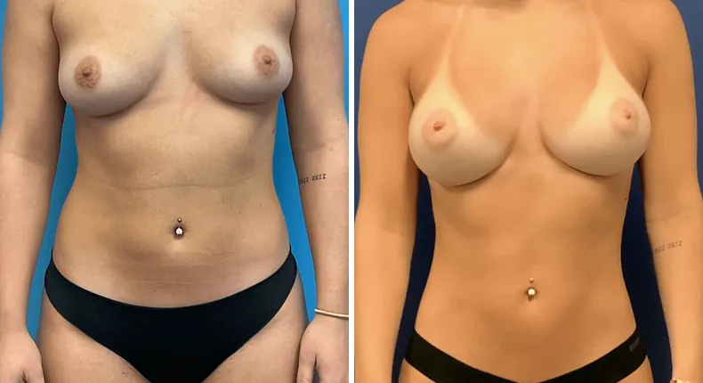 Before and after breast augmentation: patient's breasts from the front