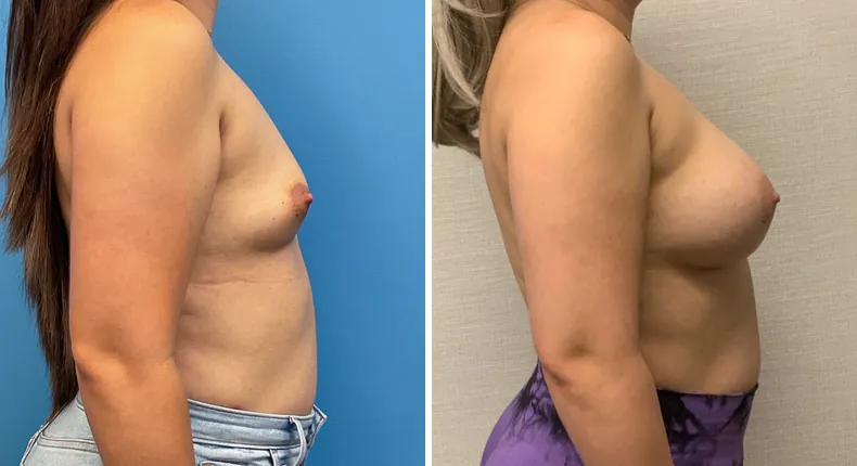 Before and after breast augmentation: woman's breasts from the right side