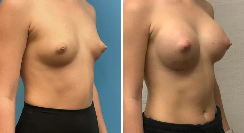 Before and after breast augmentation: patient's breasts at a right angle