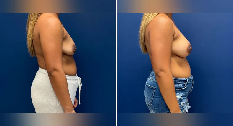 Before and after breast augmentation: woman's breasts