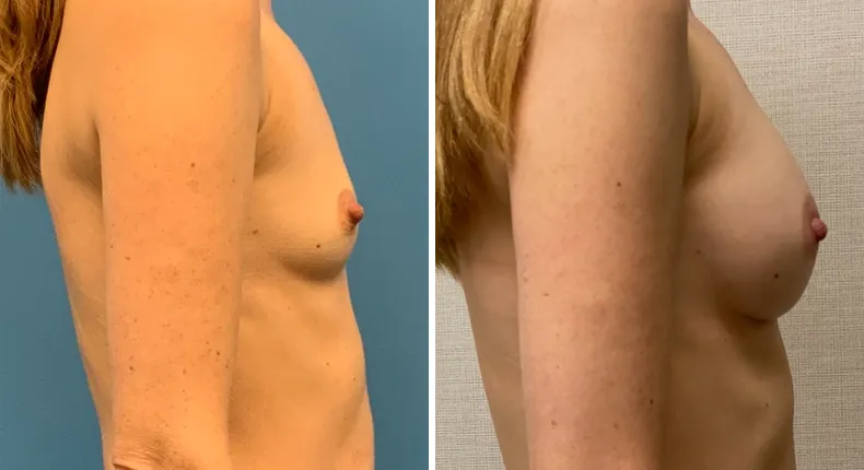 Before and after breast augmentation: woman's breasts in right profile