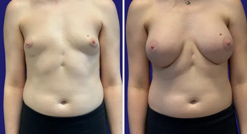 Before and after breast augmentation: patient's breasts from the front