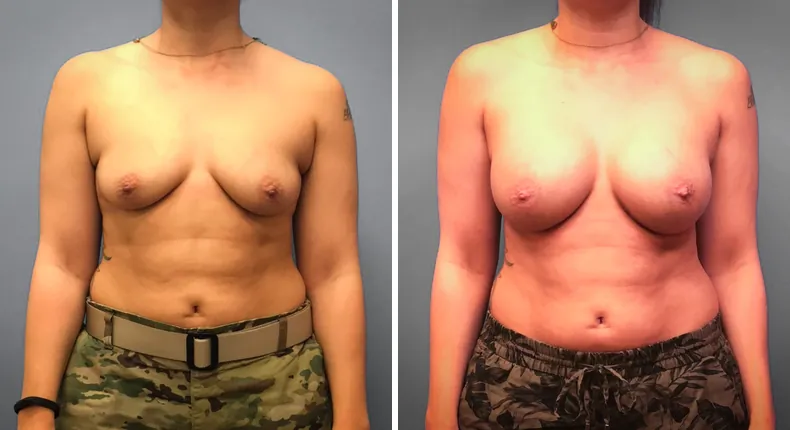 Before and after breast augmentation: patient's breasts from the front