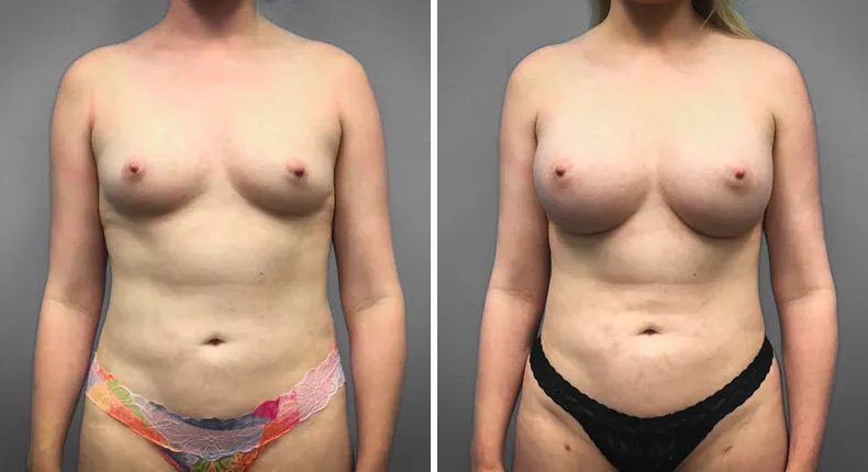 Before and after breast augmentation: patient's breasts