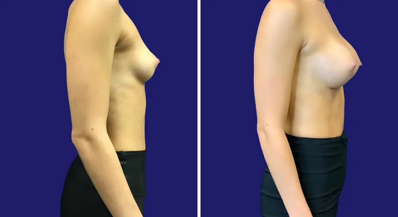 Before and after breast augmentation: woman's breasts