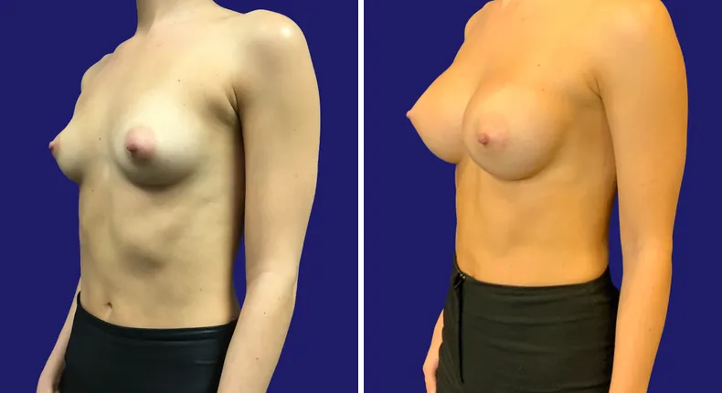 Before and after breast augmentation: woman's breasts