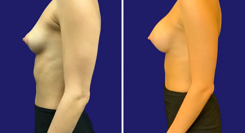 Before and after breast augmentation: woman's breasts