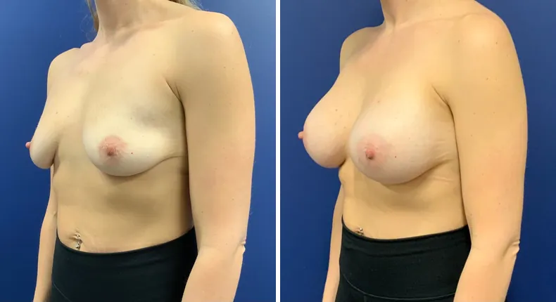 Before and after breast augmentation: woman's breasts at a left angle