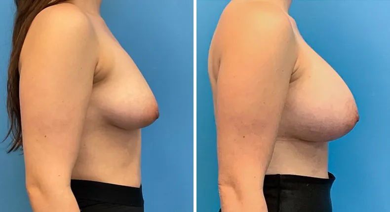Before and after breast augmentation: patient's breasts from the right side