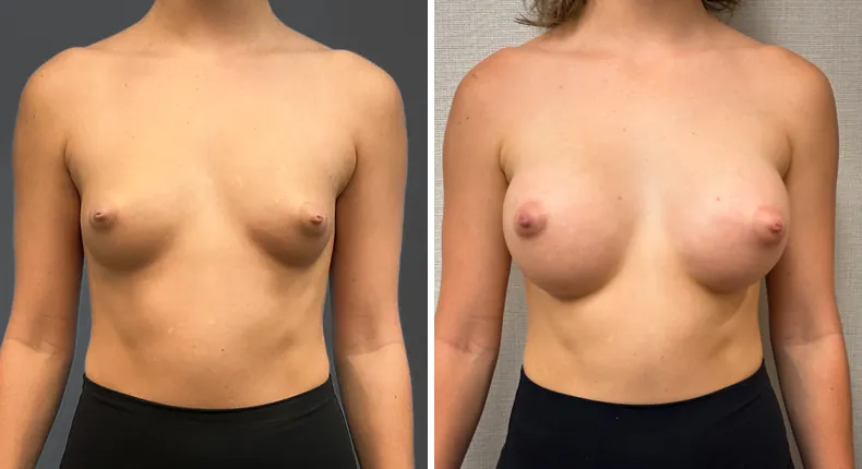 Before and after breast augmentation: woman's breasts from the front