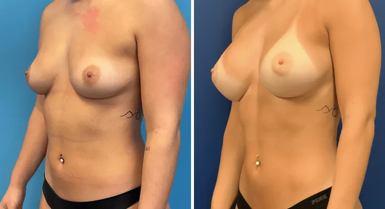 Before and after breast augmentation: patient's breasts at a left angle