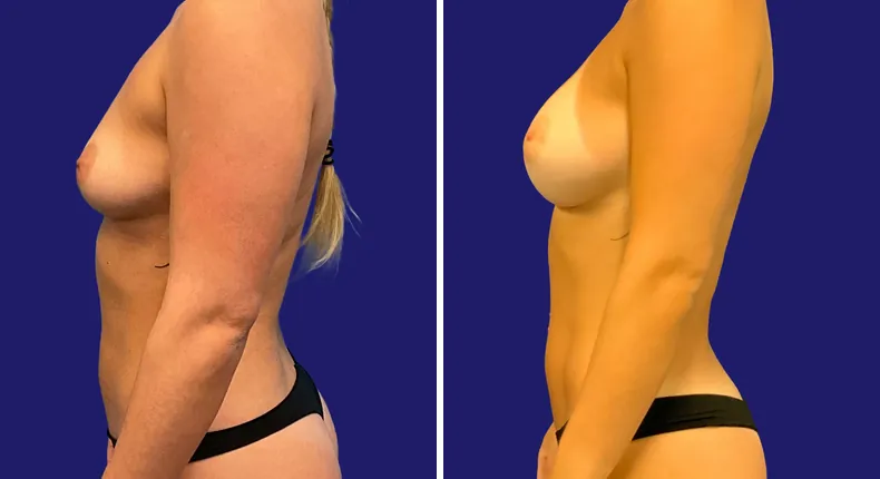 Before and after breast augmentation: woman's breasts, with liposuction and mommy makeover