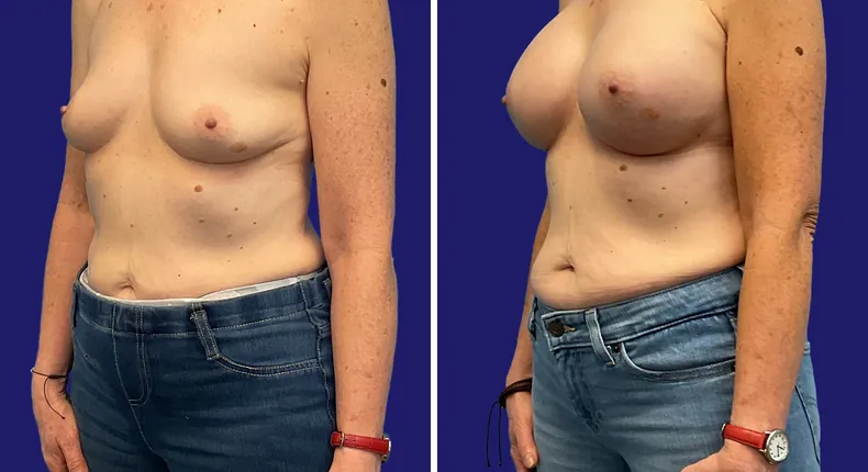 Before and after breast augmentation: woman's breasts