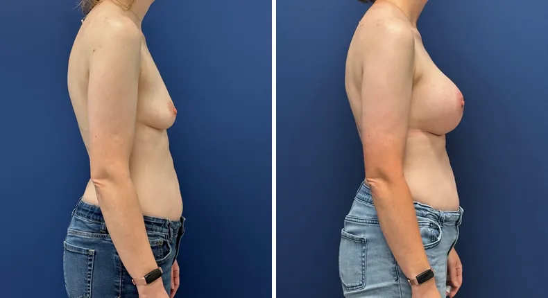 Before and after breast augmentation: patient's breasts from the right side