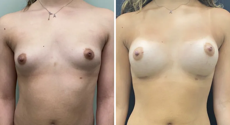 Before and after breast augmentation: woman's breasts from the front