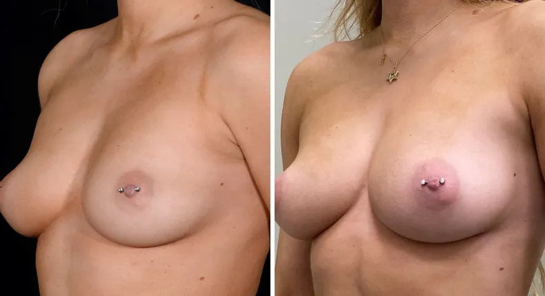 Before and after breast augmentation: patient's breasts at a left angle