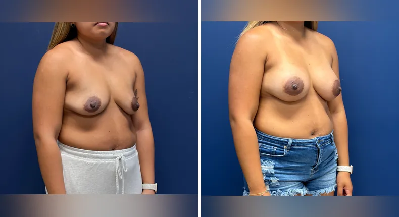 Before and after breast augmentation: woman's breasts
